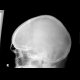 Fissure of the skull: X-ray - Plain radiograph